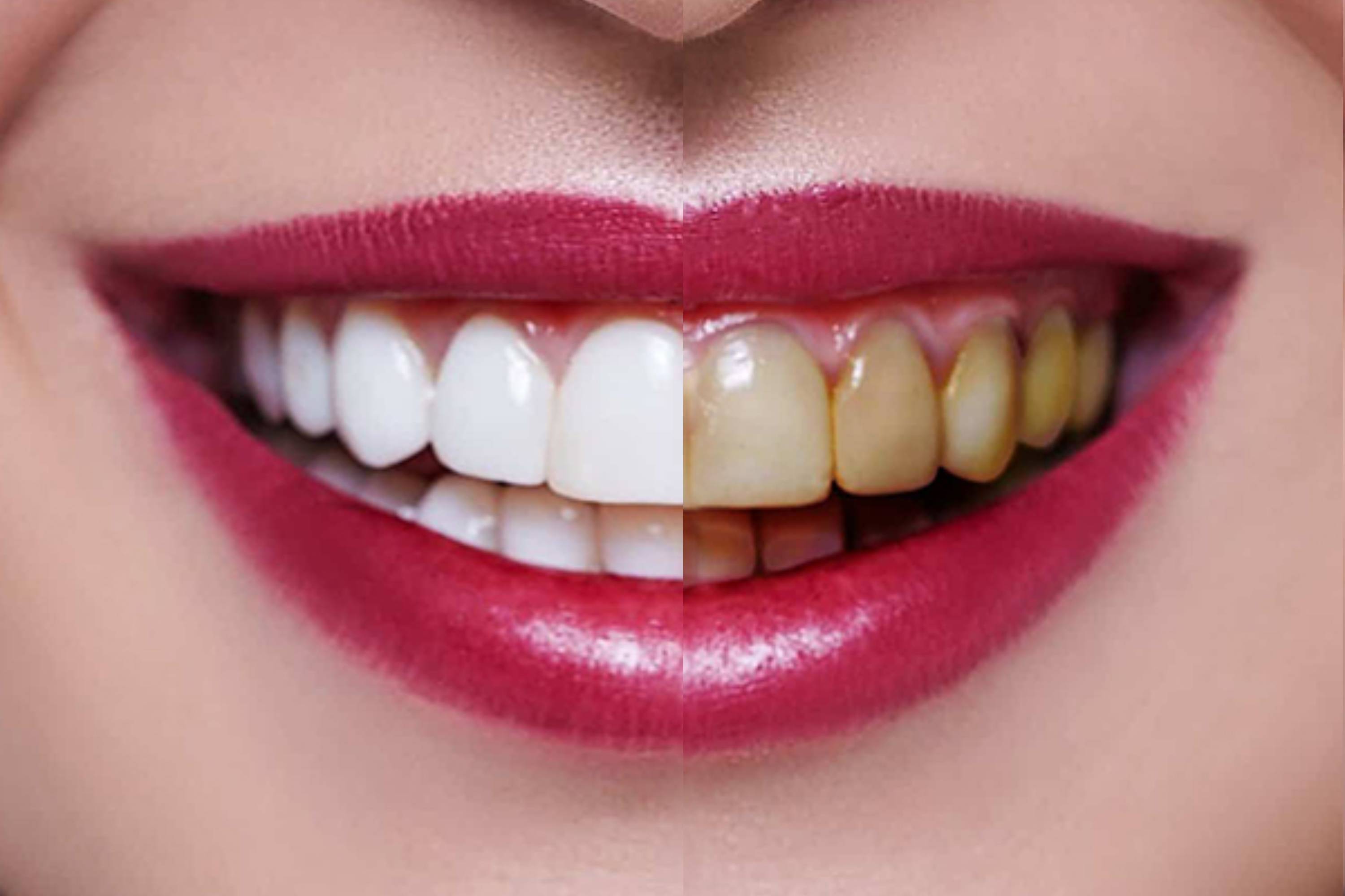 Whitening Teeth and Eyes in Bangladesh